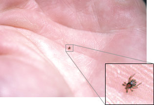 Nymphal western black-legged tick on the palm of a hand