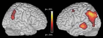 MRI scan of brain