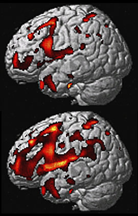MRI scans of FTLD brain