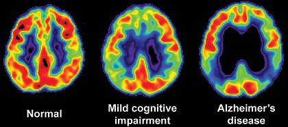 PET scans of normal, impaired and Alzheimer's brains